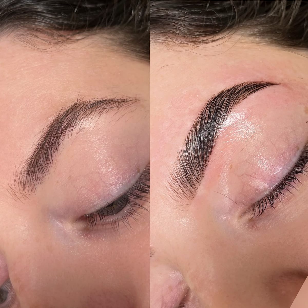 Brow lift